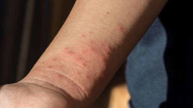 image of bed bug bites on someone's arm